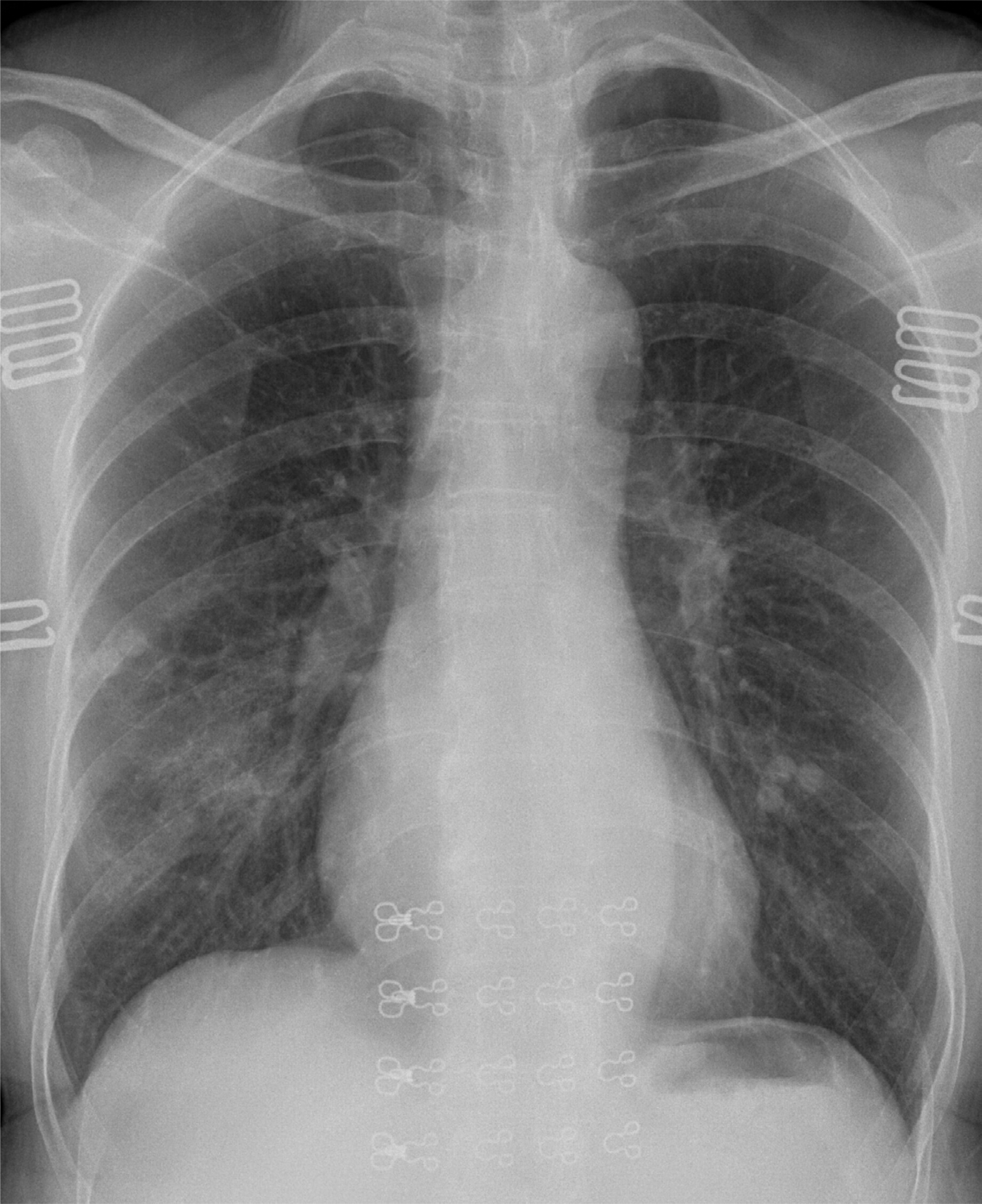 Faint patchy airspace opacities at presentation